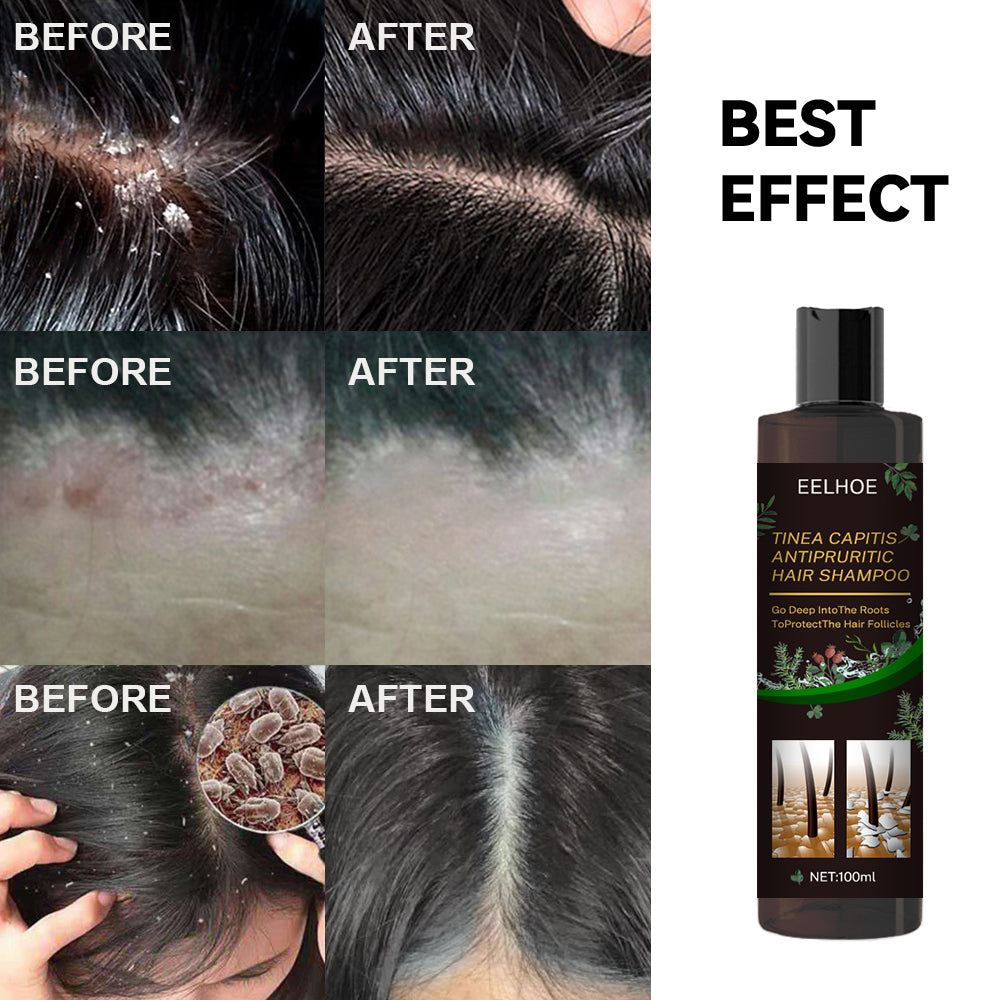 Tinea Capitis Anti-Itch Shampoo Anti-Drop Refreshing Oil Control Hair Care Anti-Dandruff Anti-Itch Shampoo
