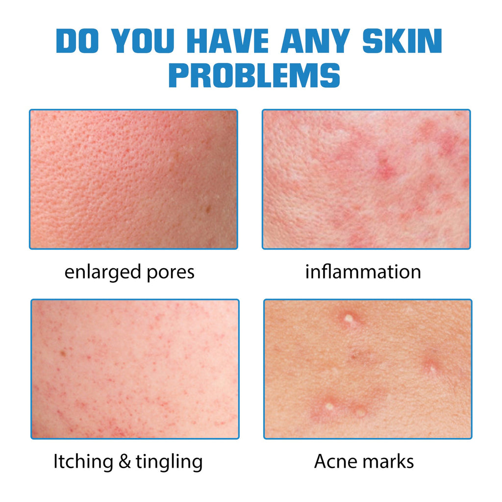 Hyaluronic Acid Face Serum, Moisturizing Repair Lighten Acne Mark Skin Care Whitening Essence