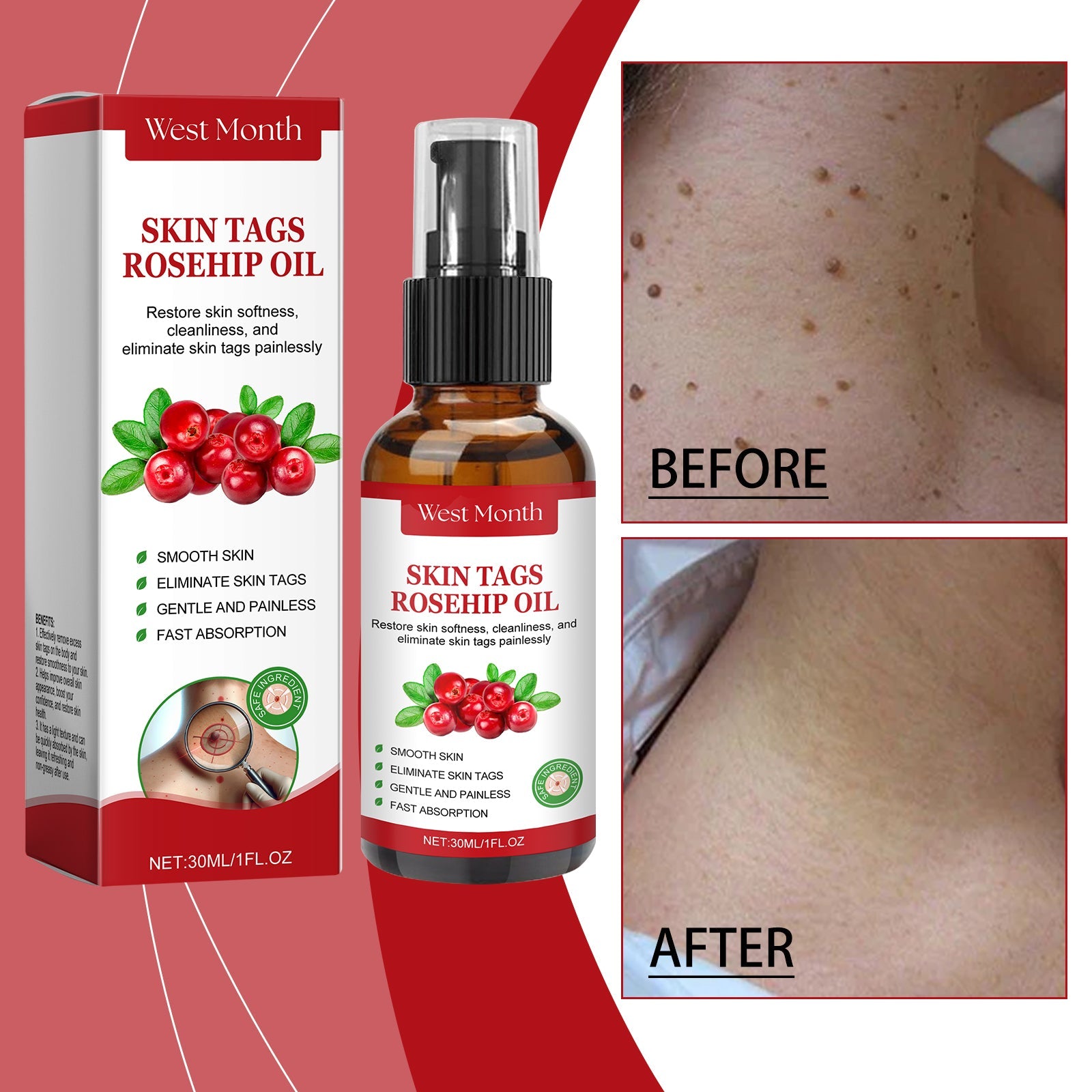 Rosehip Seed And Wart Essence Oil, Moisturizes And Restores Smooth Skin