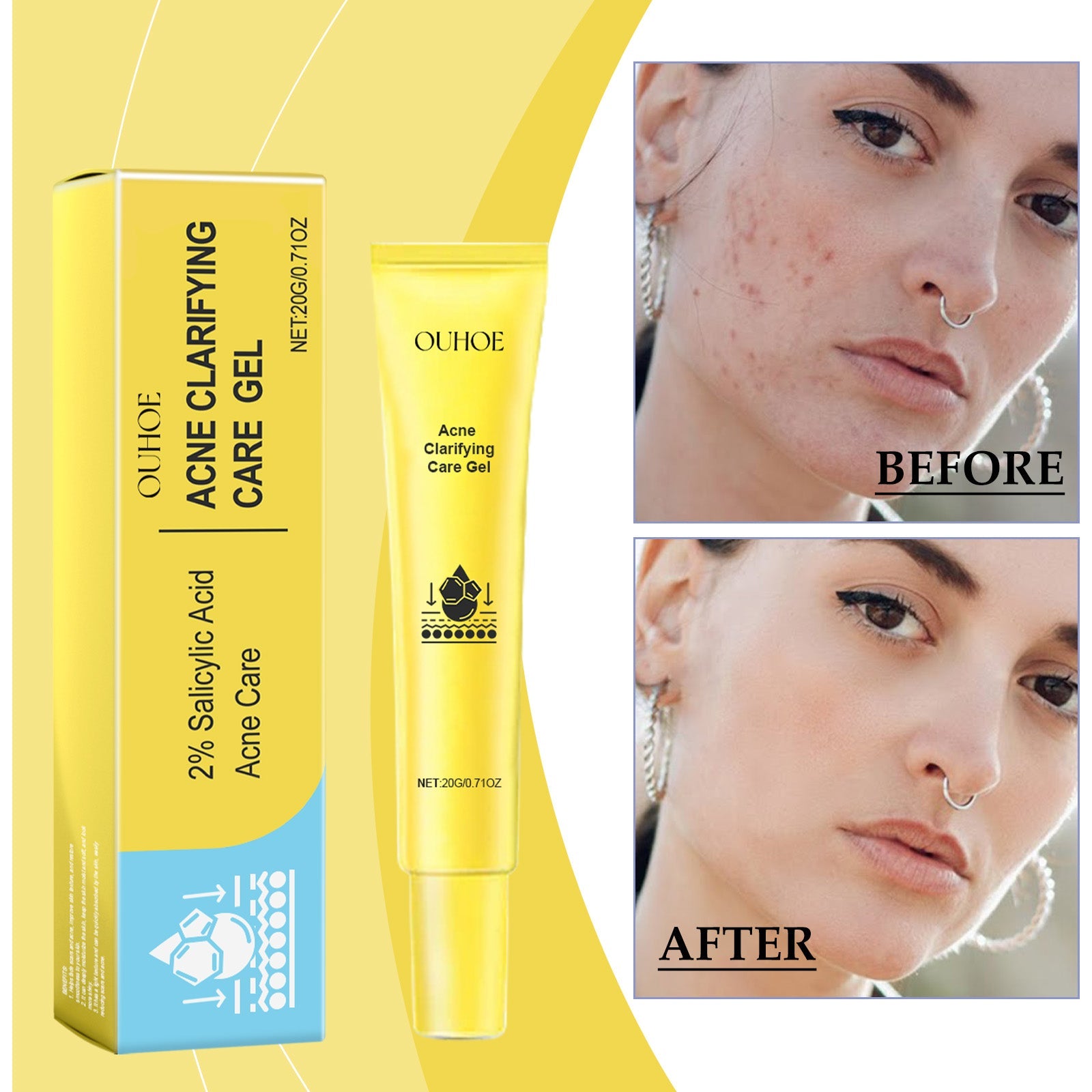 Acne-Clearing Gel, Deep Cleansing Facial Skin Brightening And Concealer Treatment Gel For Acne Reduction