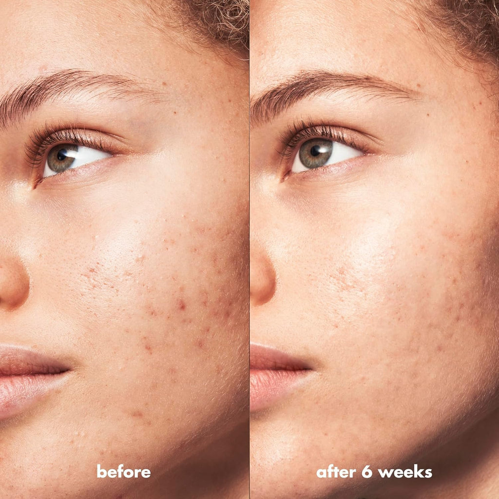 e.l.f SKIN Blemish Breakthrough Calming Water Cream